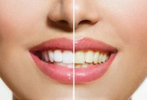 teeth with and without veneers